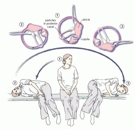 Repositioning maneuvers for BPPV